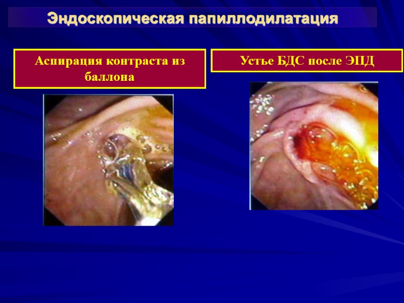 Эндоскопическая папиллодилатация Аспирация контраста из баллона Устье БДС после ЭПД